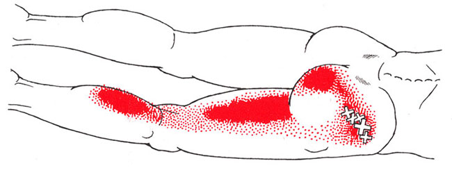 Sciatica trigger points