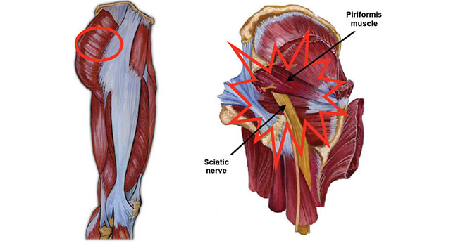 Piriformis syndrome illustration